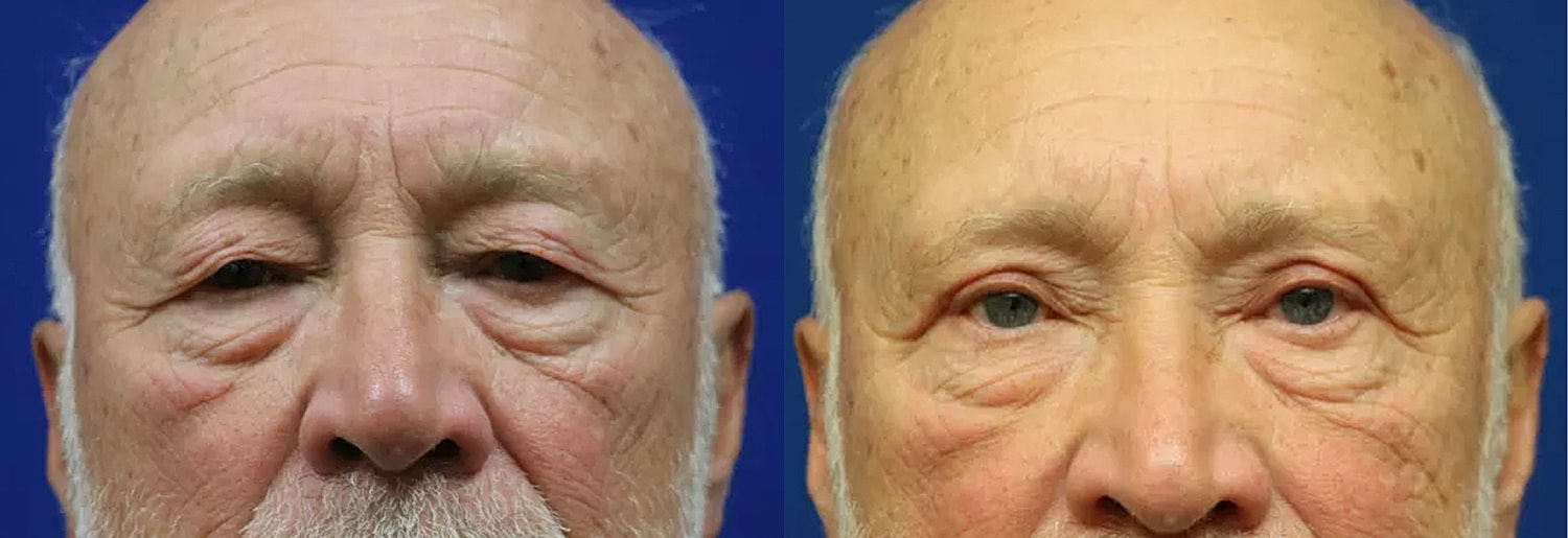 Close-up of an elderly man's face.