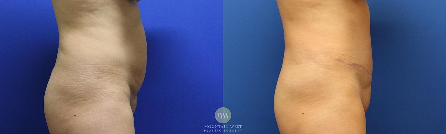 Liposuction Before & After