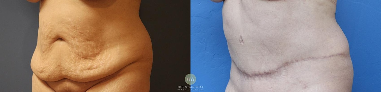 Liposuction Before & After