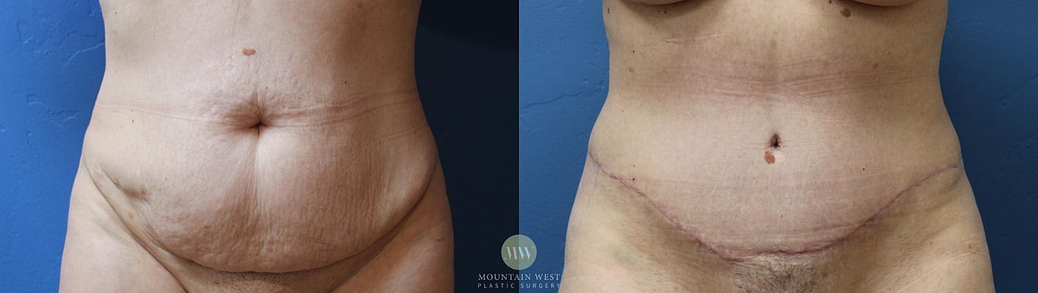 Liposuction Before & After