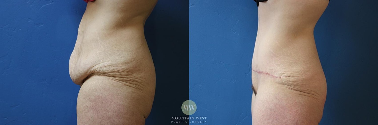 Liposuction Before & After