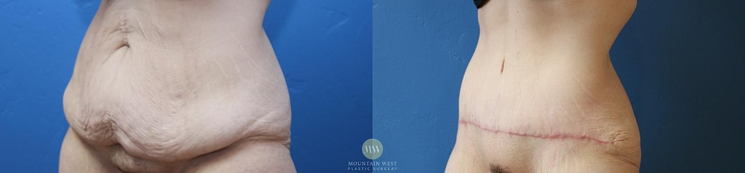 Liposuction Before & After