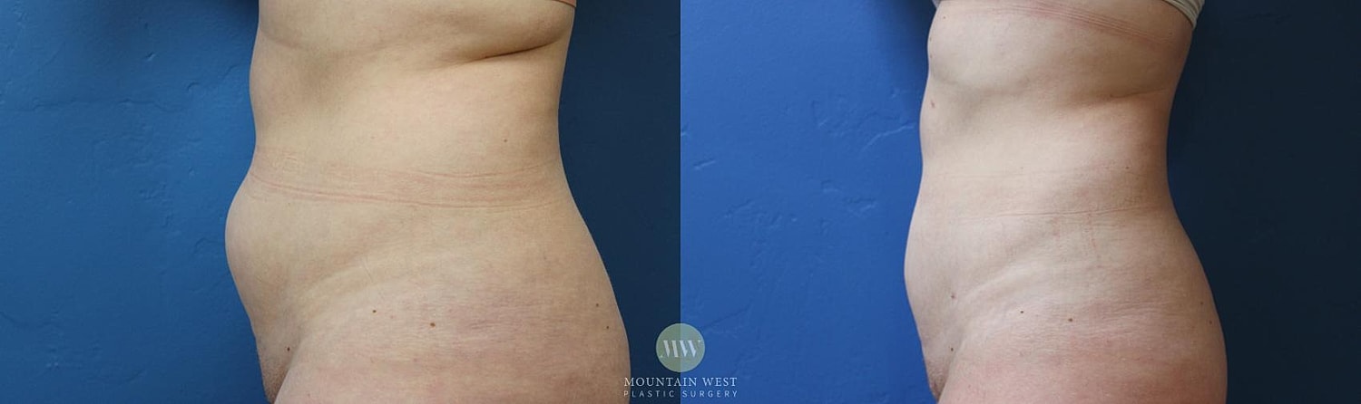 Liposuction Before & After