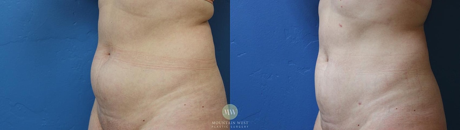 Liposuction Before & After