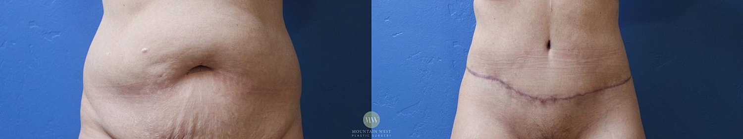 Liposuction Before & After