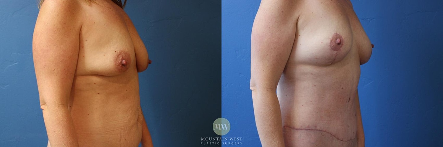 Liposuction Before & After