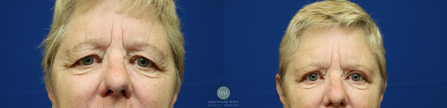Blepharoplasty Before & After