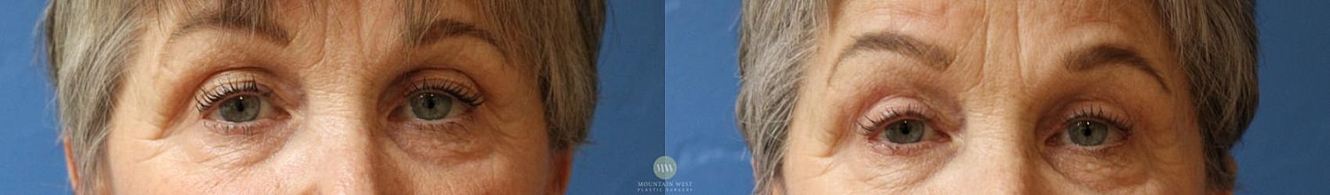 Blepharoplasty Before & After