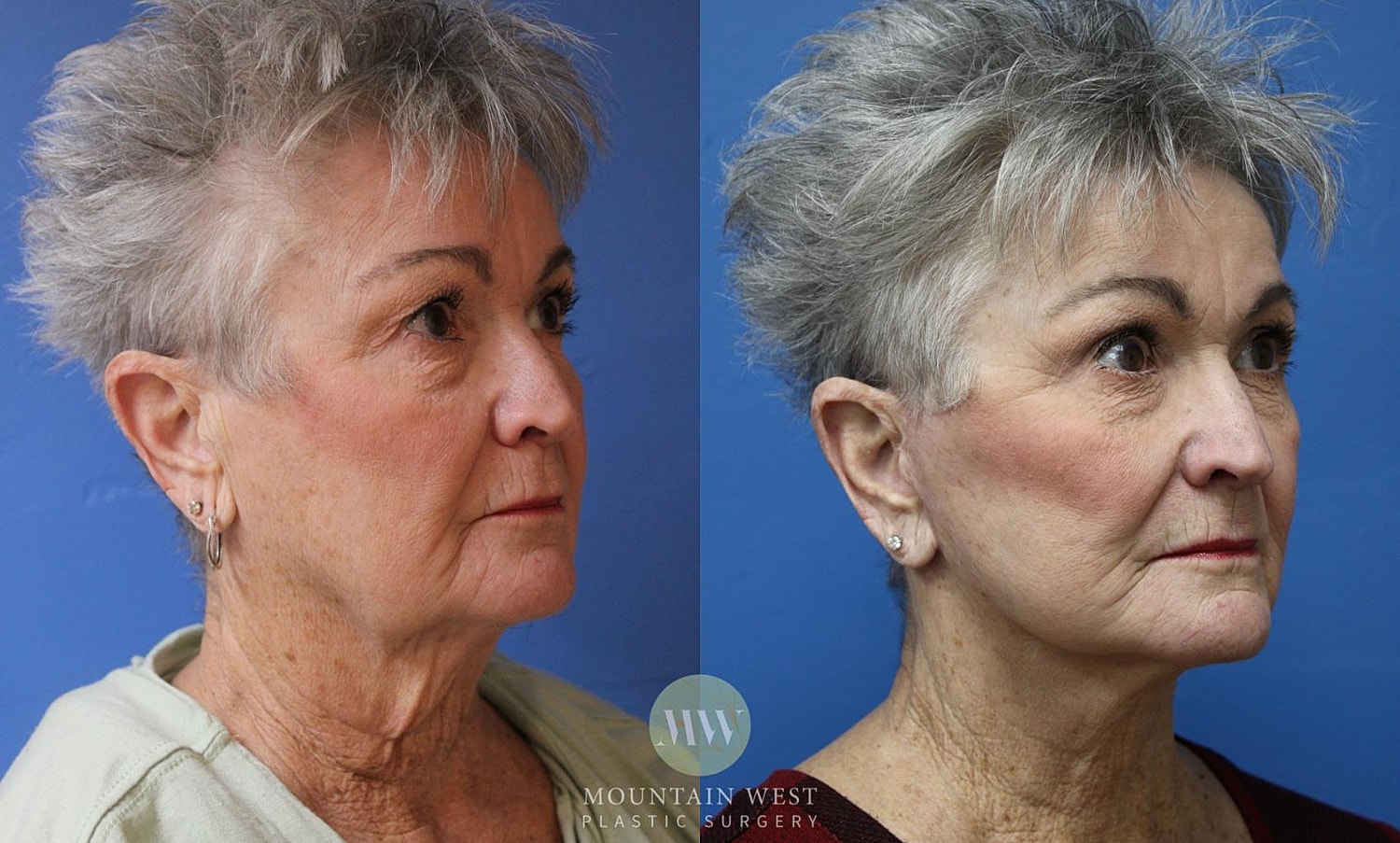 Blepharoplasty Before & After