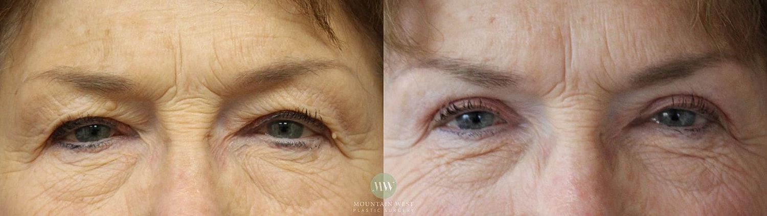 Blepharoplasty Before & After