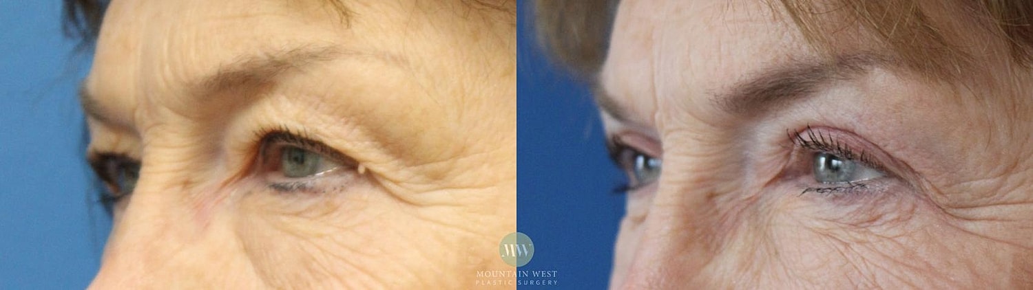 Blepharoplasty Before & After