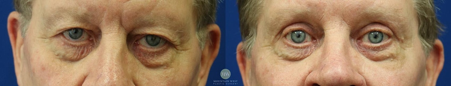 Blepharoplasty Before & After