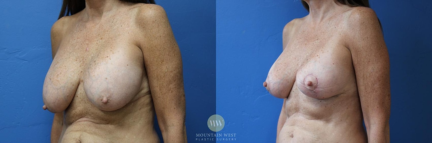Breast Implant Removal Before & After