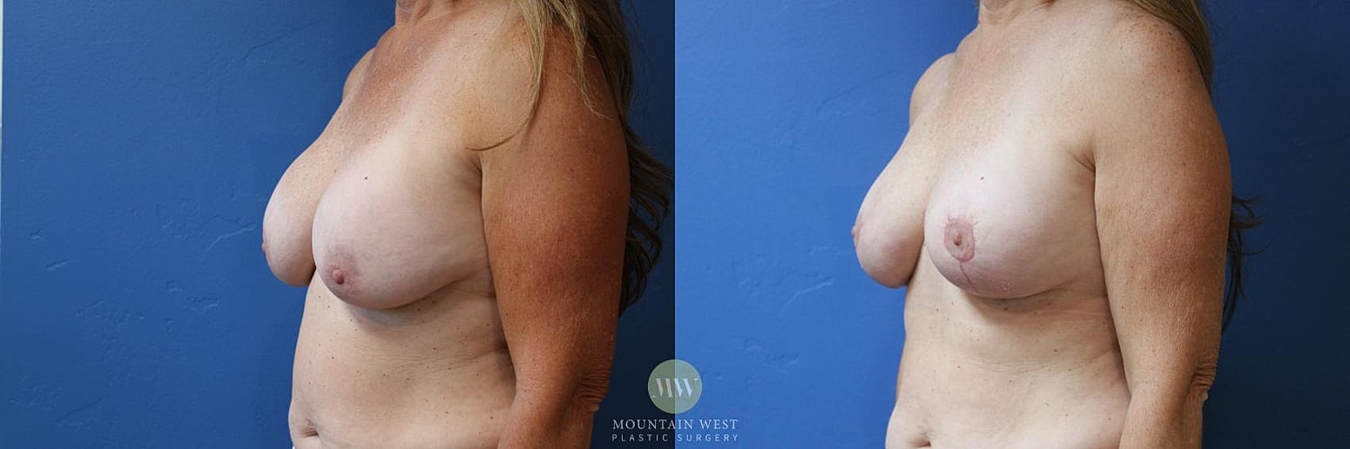 Breast Implant Removal Before & After