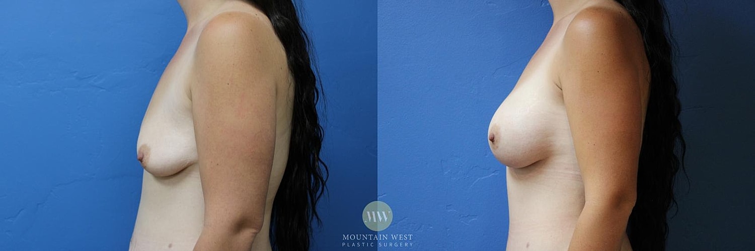 Breast Surgery After Weight Loss Before & After