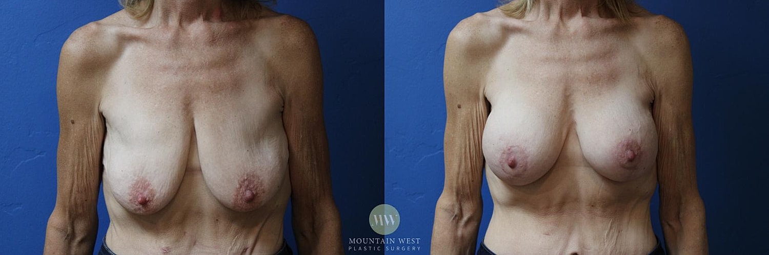 Breast Surgery After Weight Loss Before & After