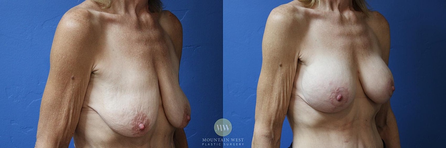 Breast Surgery After Weight Loss Before & After