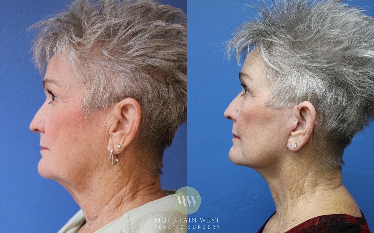 Facelift Before & After