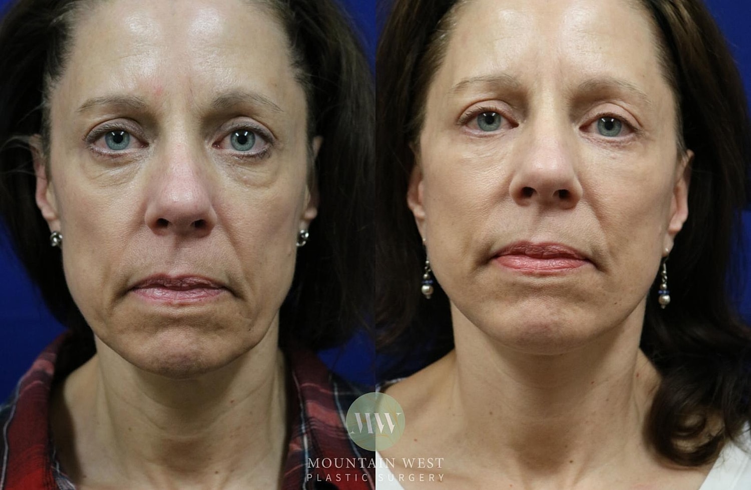 Facelift Before & After
