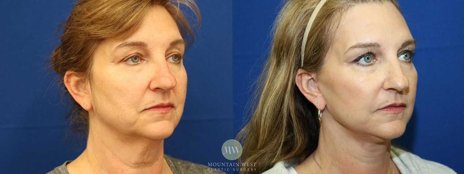 Facelift Before & After