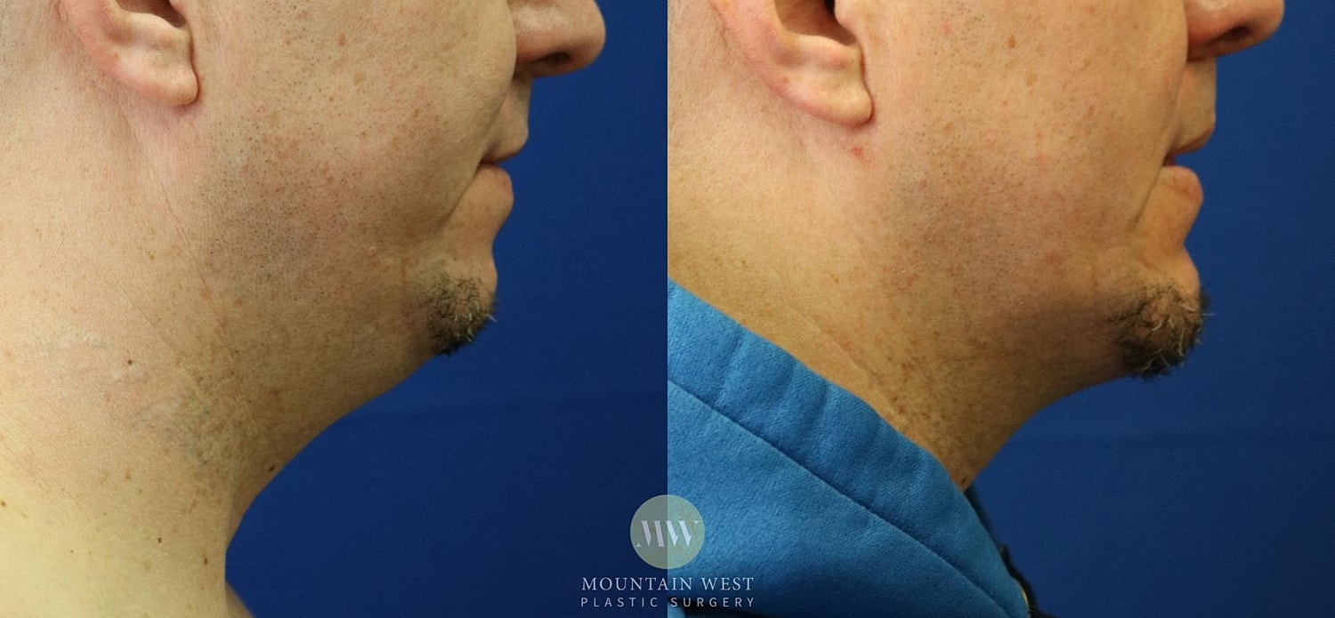 Chin Augmentation With Implant Before & After