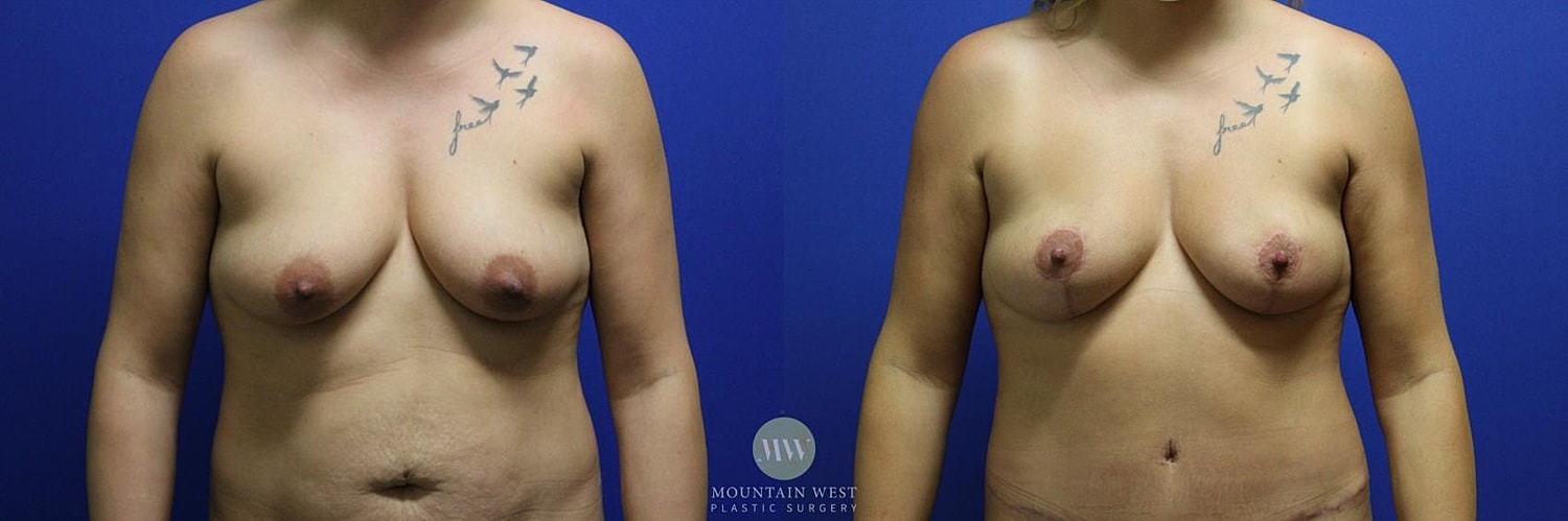 Breast Lift Before & After
