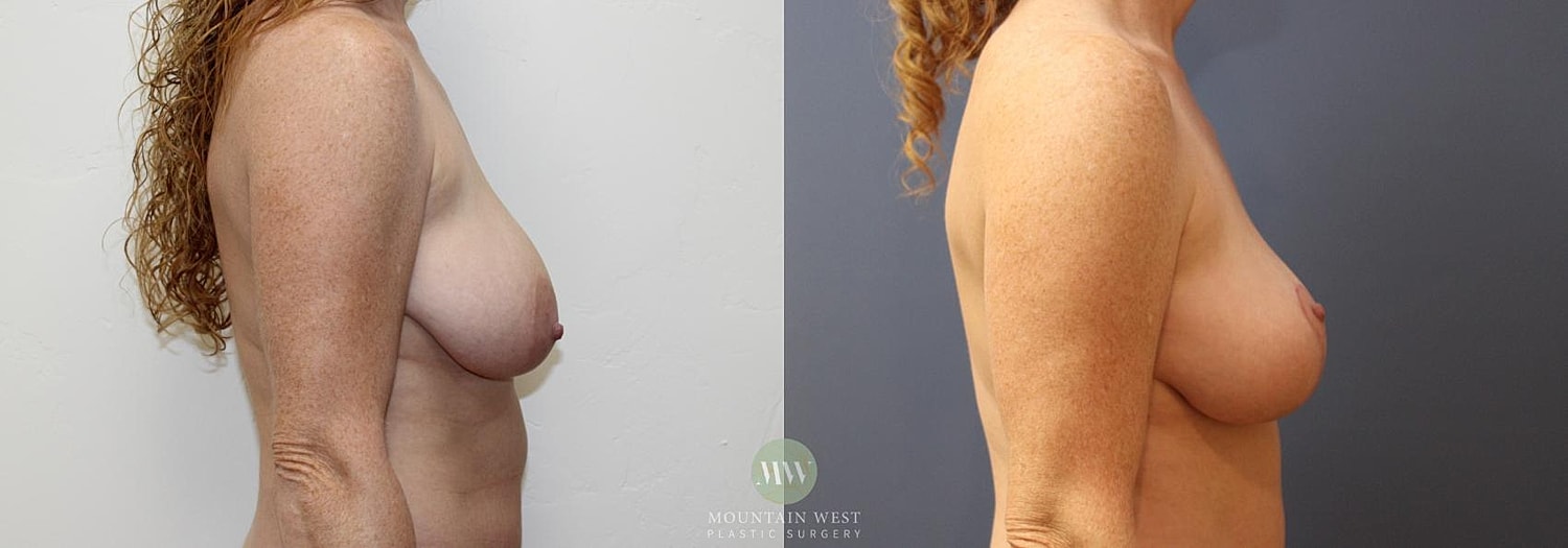 Breast Lift Before & After