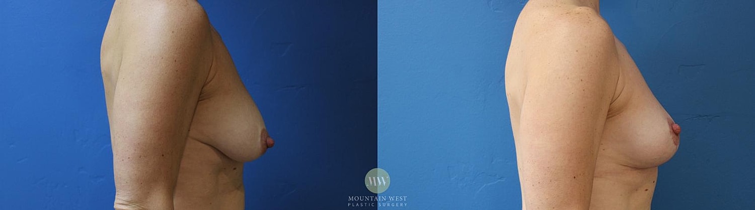 Breast Lift Before & After