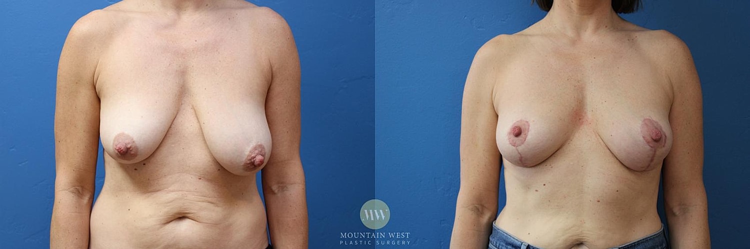 Breast Lift Before & After