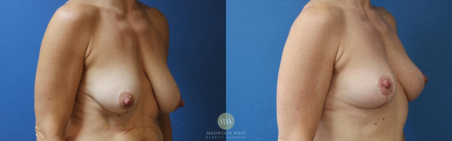 Breast Lift Before & After
