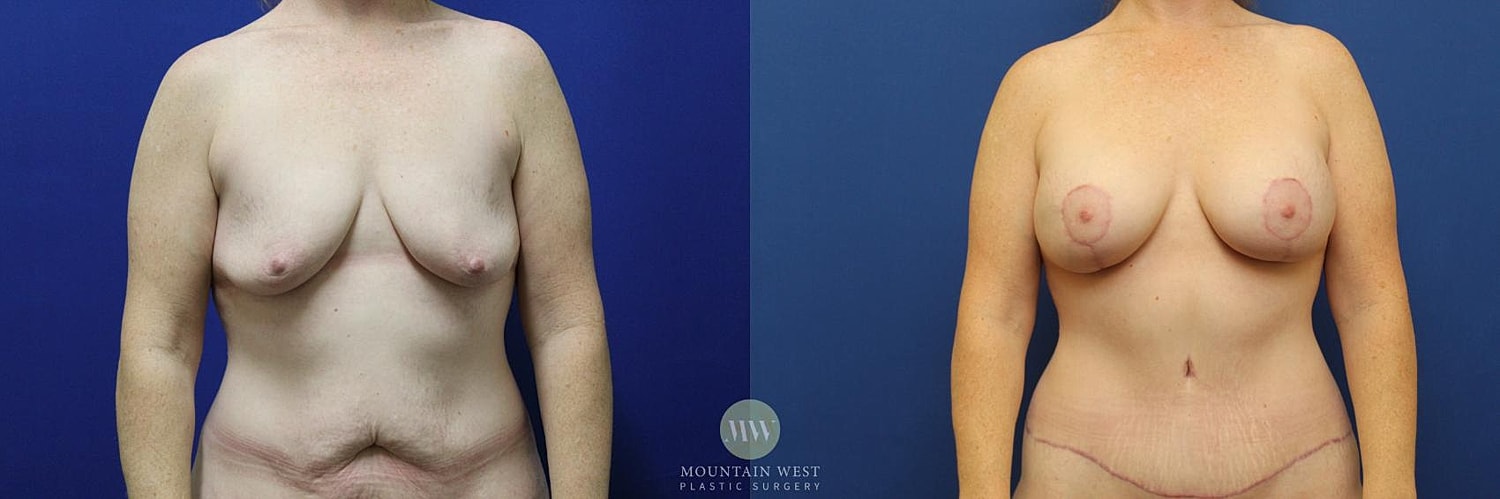 Mommy Makeover Before & After