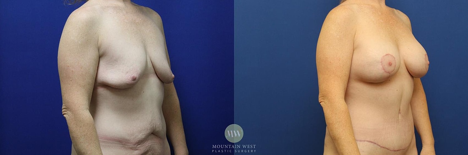 Mommy Makeover Before & After