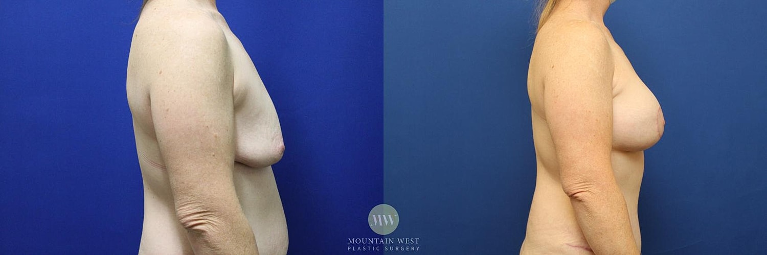 Mommy Makeover Before & After