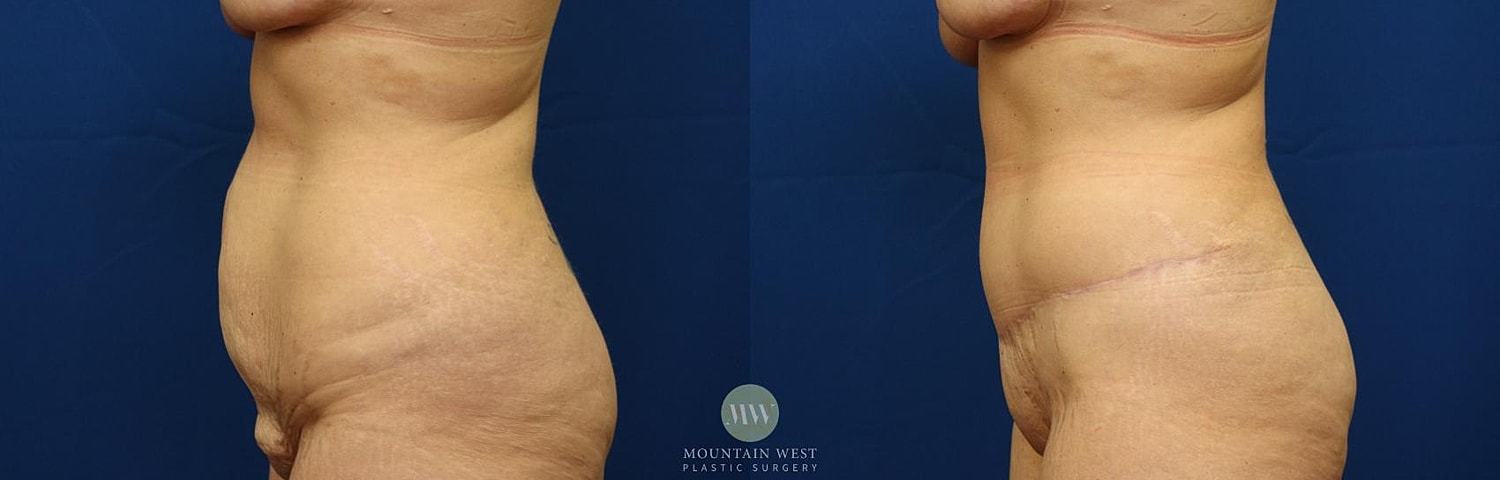 Tummy Tuck Before & After