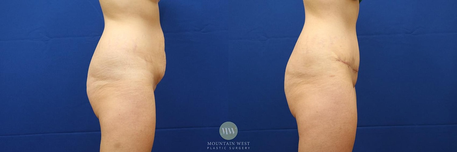 Tummy Tuck Before & After