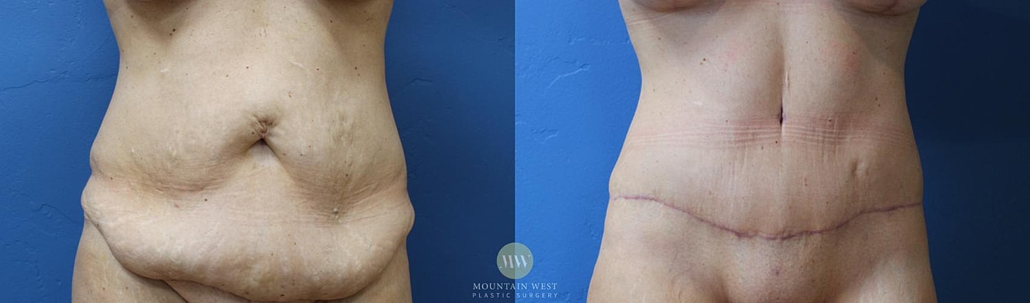Tummy Tuck Before & After