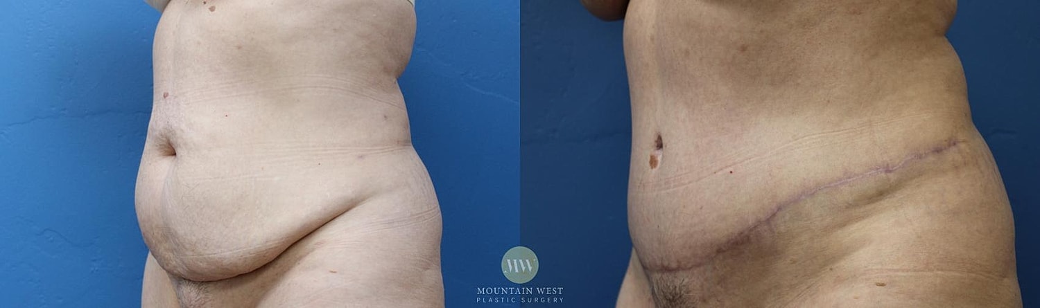 Tummy Tuck Before & After