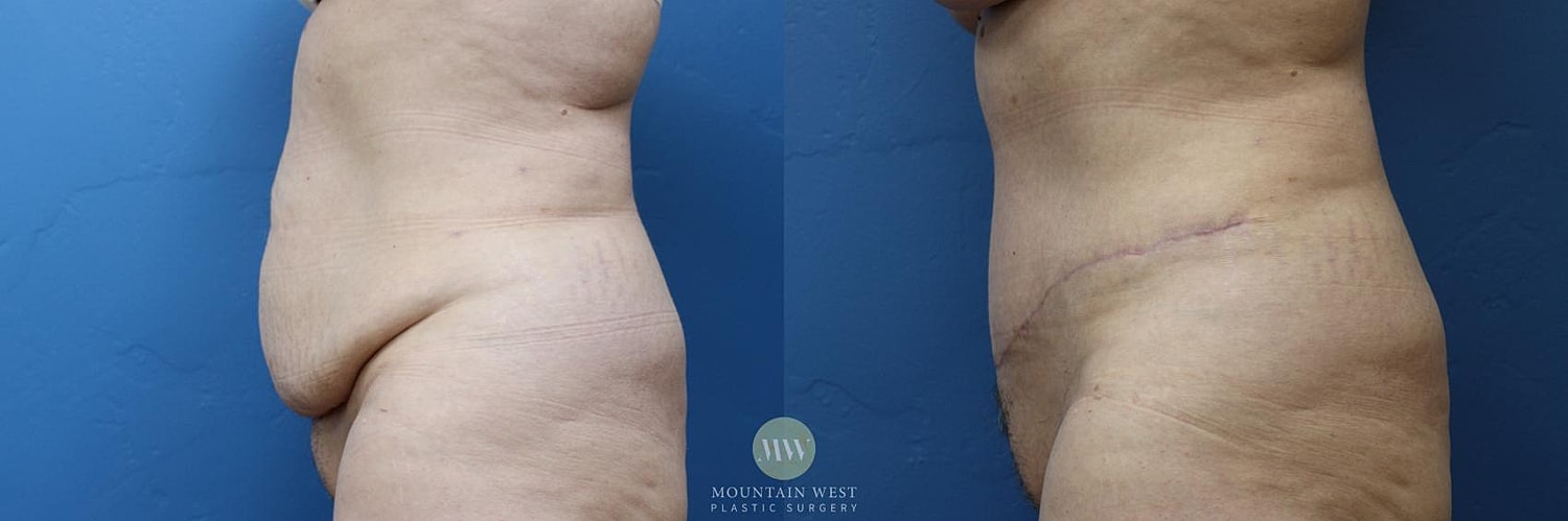 Tummy Tuck Before & After