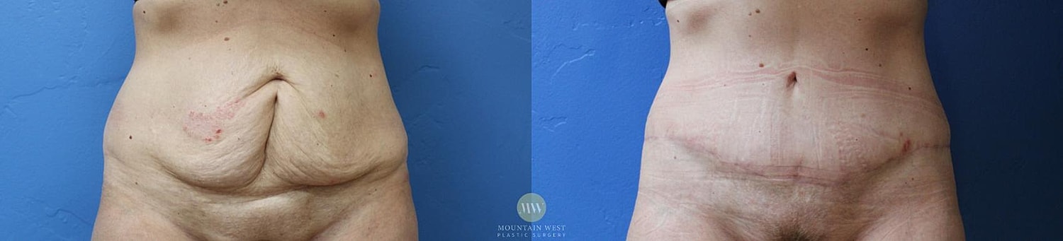 Tummy Tuck Before & After