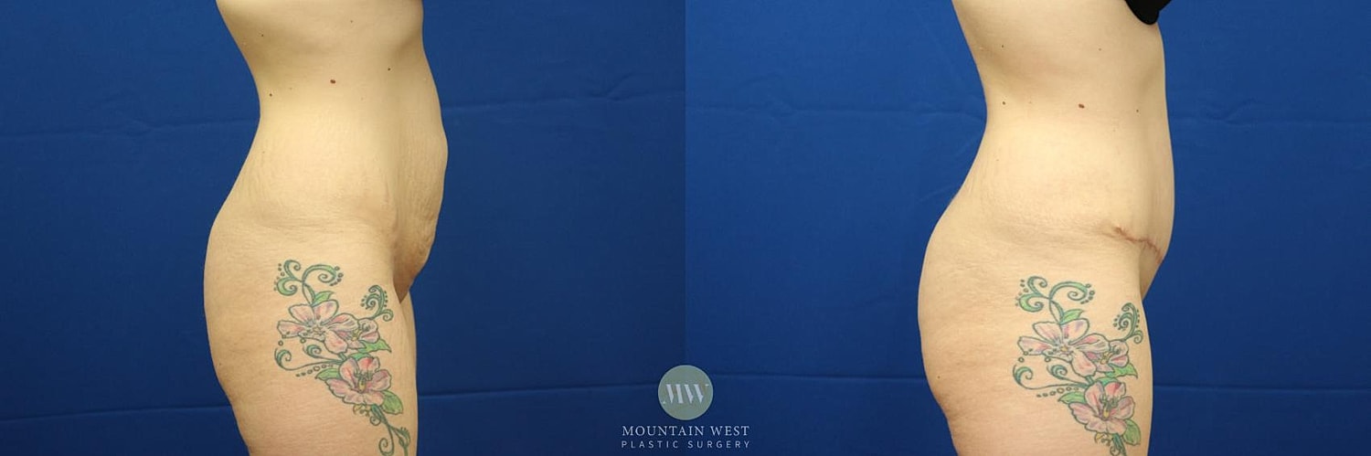 Tummy Tuck Before & After