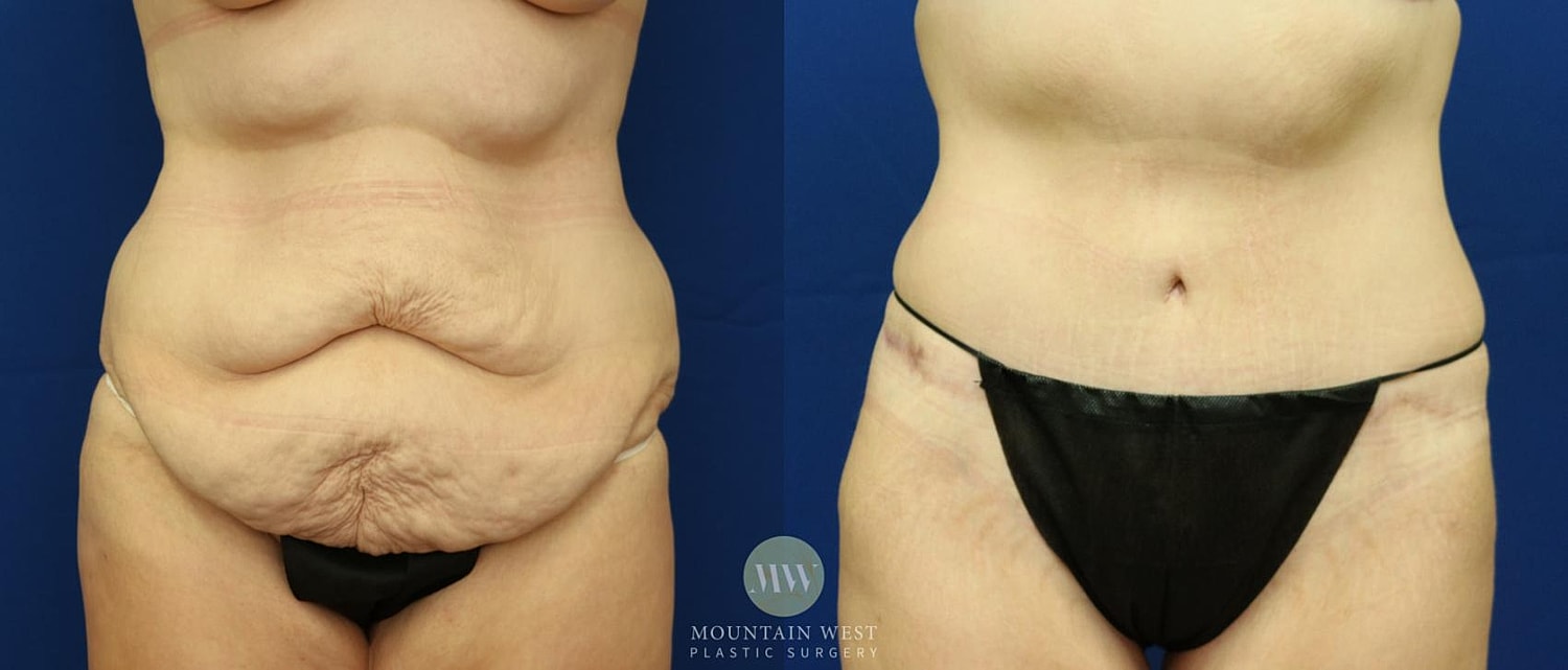Tummy Tuck Before & After