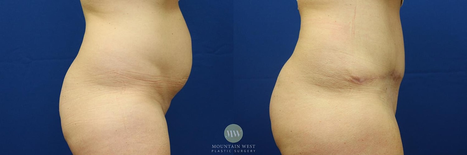 Tummy Tuck Before & After