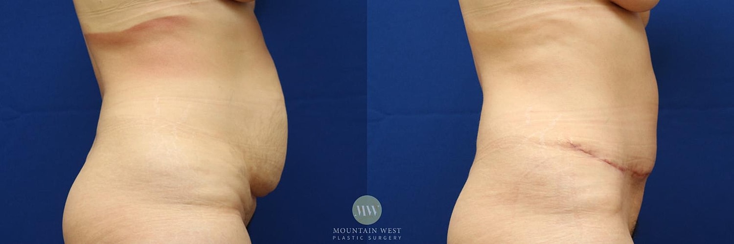 Tummy Tuck Before & After