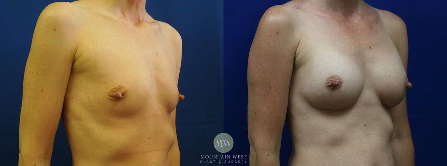 Breast Augmentation Before & After