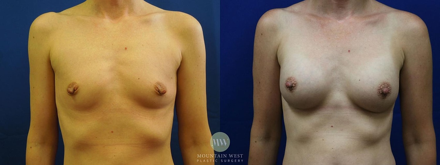 Breast Augmentation Before & After