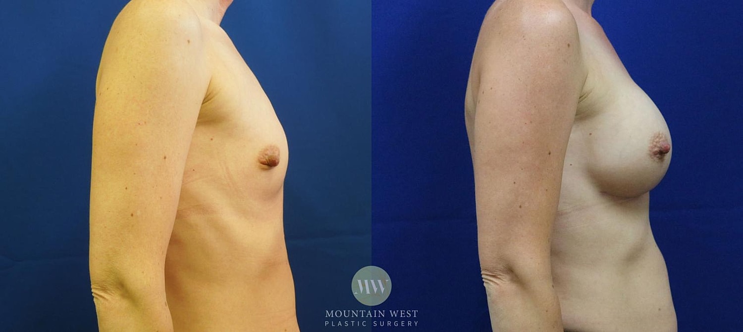 Breast Augmentation Before & After