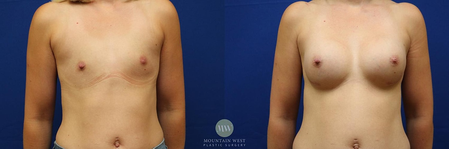 Breast Augmentation Before & After