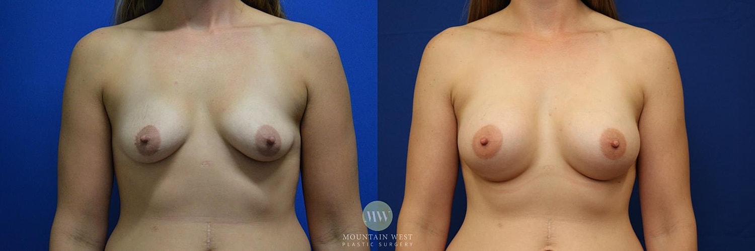 Breast Augmentation Before & After