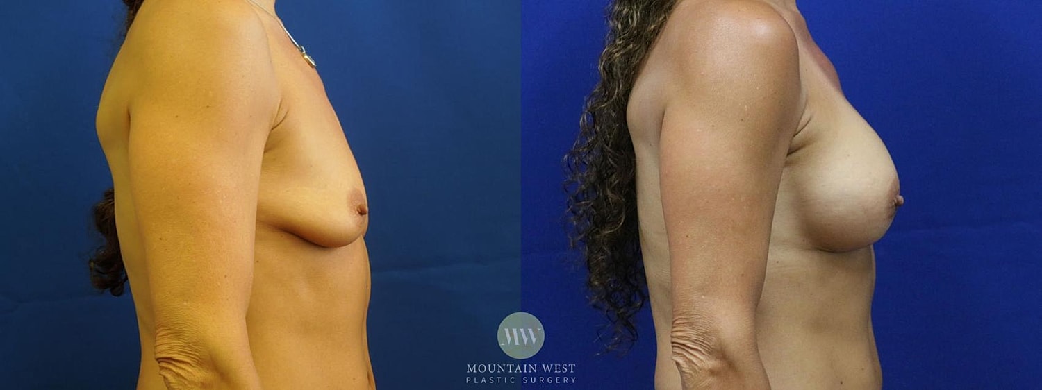 Breast Augmentation Before & After