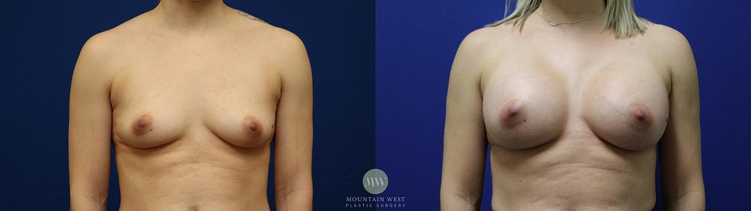 Breast Augmentation Before & After